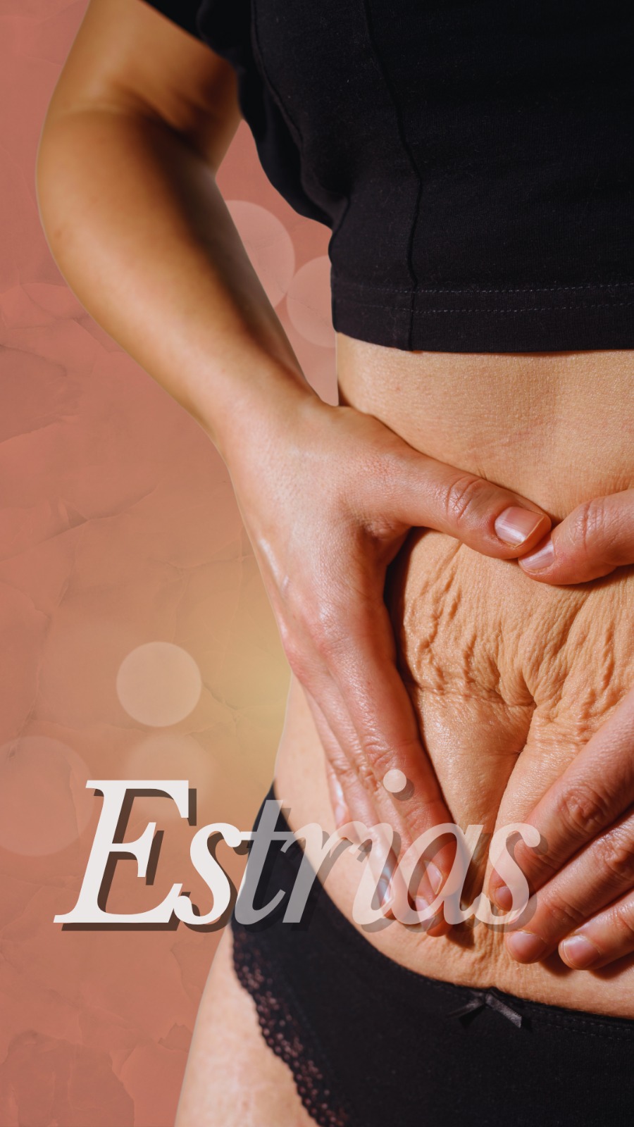 Tratamento para estrias - Clínica Elevar