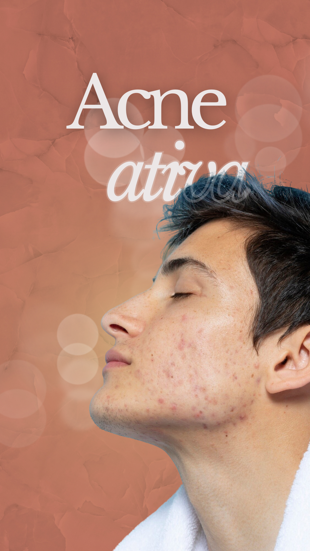 Tratamento para acne ativa - Clínica Elevar