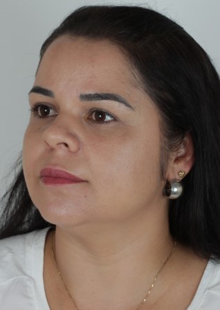 Antes do tratamento para redução de papada - Clínica Elevar