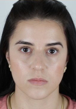 Antes do tratamento de estímulo de colágeno facial - Clínica Elevar