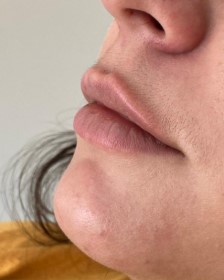 Antes do tratamento para realce de lábios - Clínica Elevar