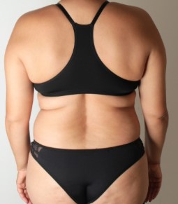 Antes do tratamento corporal para redução de medidas - Clínica Elevar