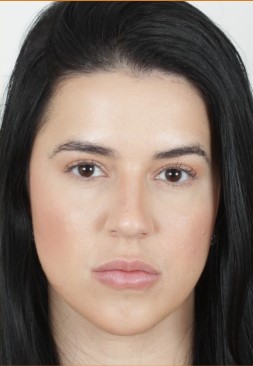 Depois do tratamento de estímulo de colágeno facial - Clínica Elevar