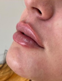 Depois do tratamento para realce de lábios - Clínica Elevar