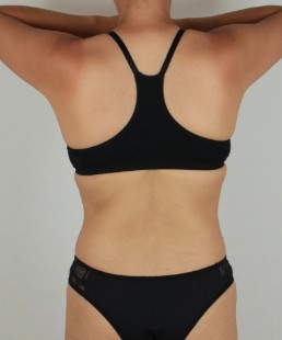 Depois do tratamento corporal para redução de medidas - Clínica Elevar