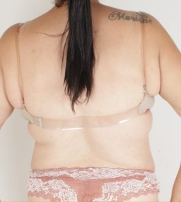 Depois do tratamento para firmeza abdominal - Clínica Elevar